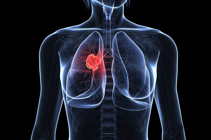đông trùng hạ thảo có tác dụng với ung thư phổi di căn